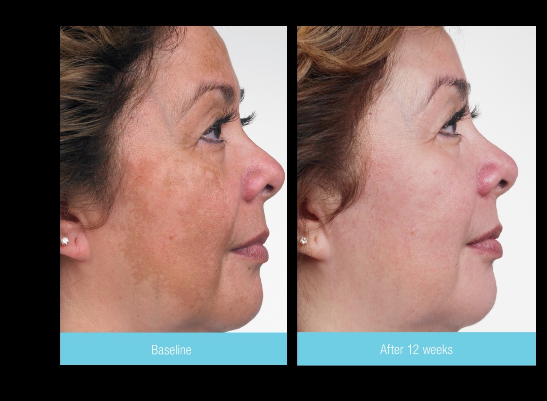 Pigmentation treatment at DermaSpa Ajax Pickering
