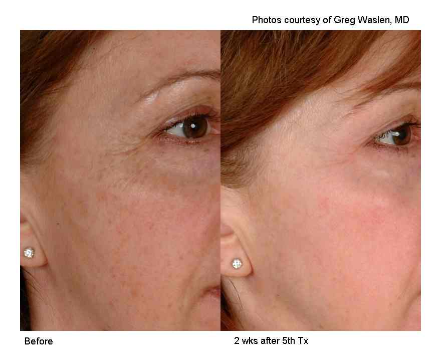 Sun Spot Treatment Pickering Ajax Whitby 