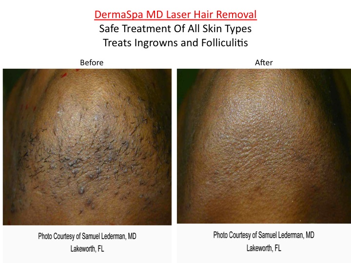 Laser Treatment Folliculitis